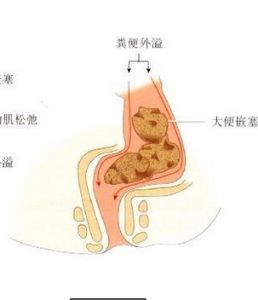大便失禁 大便失禁