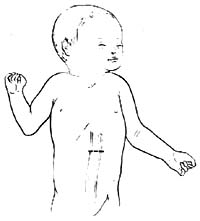新生兒肛門和直腸畸形