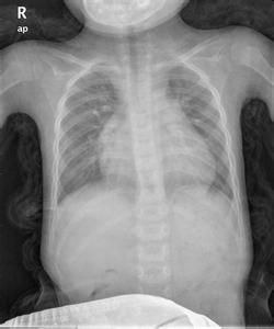 完全性心內膜墊缺損