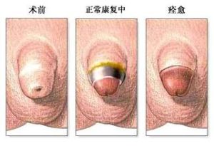 包皮包莖 包皮包莖