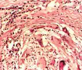 異物肉芽腫 異物肉芽腫