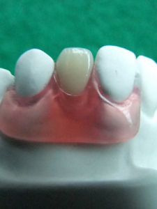 隱形義齒 隱形義齒