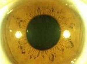 鞏膜黃染 鞏膜黃染