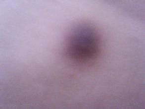 皮下纖維瘤 皮下纖維瘤