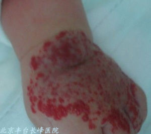 小兒混合型血管瘤