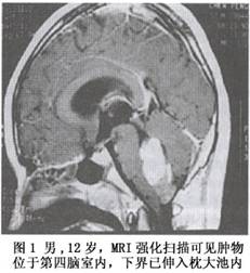 （圖）顱後窩室管膜瘤