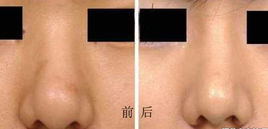 鼻翼縮小 鼻翼縮小