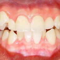 脊柱矯正 脊柱矯正