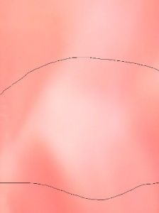 口腔黏膜白斑 口腔黏膜白斑