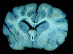 腦苷脂半乳糖苷酶 腦苷脂半乳糖苷酶