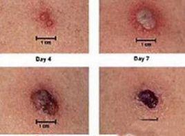 外斐氏試驗陰性 外斐氏試驗陰性