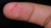 手指上的小傷口，為什麼那么疼？
