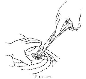 胸腔閉式引流術