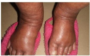 副癌綜合症 副癌綜合症