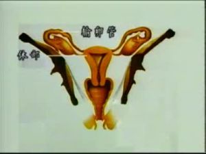 白帶豆腐渣狀 白帶豆腐渣狀