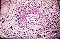 細菌感染性心肌炎