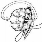 動靜脈造瘺術 動靜脈造瘺術
