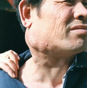 淋巴結核 淋巴結核