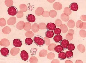 （圖）嗜鹼性粒細胞白血病