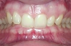 深覆牙合 深覆牙合