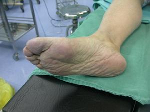 老年急性動脈栓塞