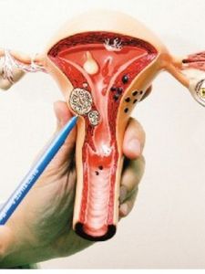 皰疹性外陰陰道炎 皰疹性外陰陰道炎