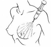 抽脂隆胸 抽脂隆胸