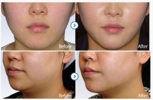 雷射溶脂提升對比圖片