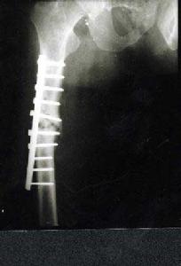 股骨粗隆間骨折