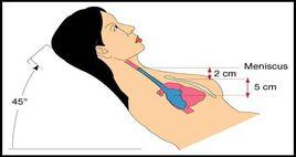 CVP[中心靜脈壓]