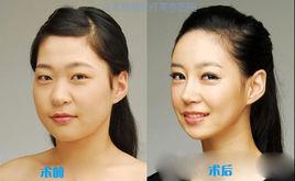 韓式分層吸脂 韓式分層吸脂