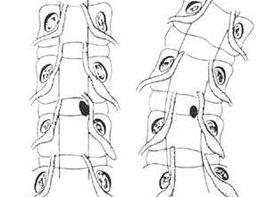 神經根激惹症狀 神經根激惹症狀