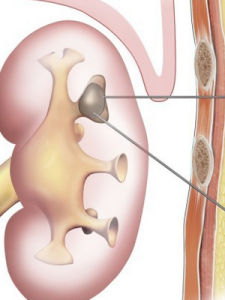 泌尿繫結石 泌尿繫結石