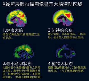 植物人狀態 植物人狀態