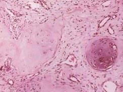 乳頭侵蝕性腺瘤病