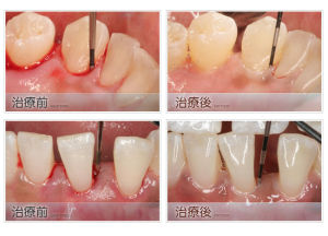 牙周牙髓聯合病變