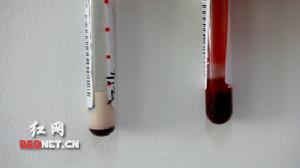 高脂蛋白血症 高脂蛋白血症