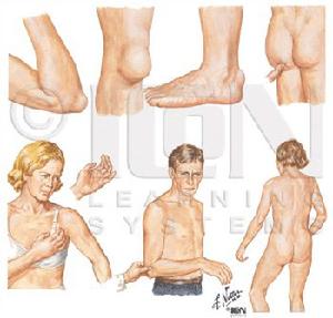 幼年型類風濕性關節炎