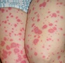 小兒滲出性多形性紅斑 小兒滲出性多形性紅斑