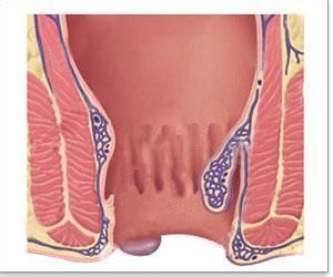 結締組織外痔 結締組織外痔
