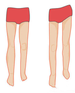 下肢不等長 下肢不等長