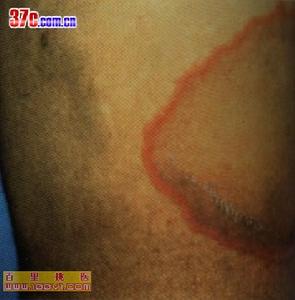 幼年型類風濕性關節炎