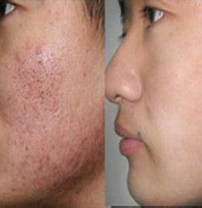 雷射痘印 雷射痘印