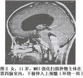（圖）顱後窩室管膜瘤
