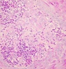 腫基被孢霉 腫基被孢霉