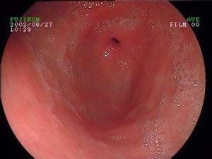 手術後反流性胃炎 手術後反流性胃炎