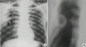 慢性肺炎 慢性肺炎