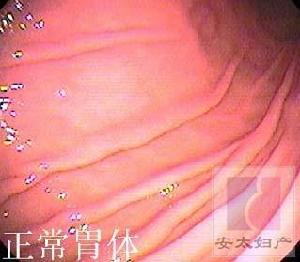 胃黏膜脫垂