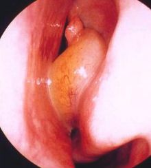 單純性鼻炎 單純性鼻炎