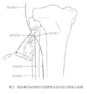 腓總神經卡壓症